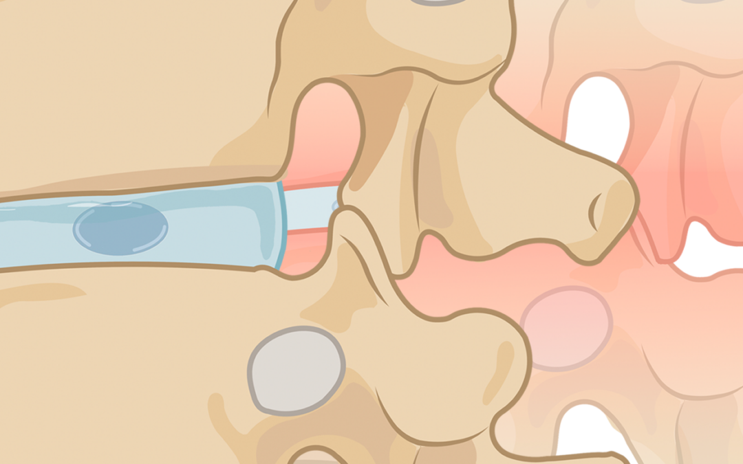 ¿Qué es el conducto cervical estrecho? Fisiopatología, diagnóstico y tratamiento